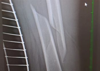 Терміново потрібна допомога: 12-річному хлопчику з родини переселенців необхідна операція – Суми та область
