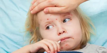 Спалах кору у Дніпрі: госпіталізували двох дітей